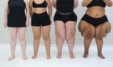 Médicos alertam para risco de distúrbio na menopausa causado pela lipedema