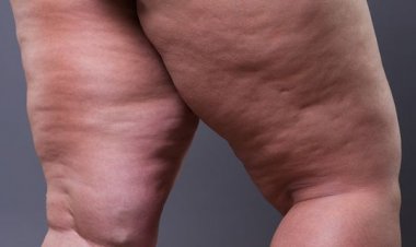 MENOPAUSA PODE DESENCADEAR LIPEDEMA: ENTENDA A RELAÇÃO HORMONAL POR TRÁS DA DOENÇA