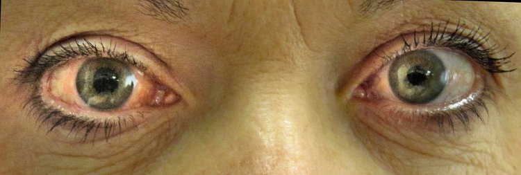 Dia Nacional de Combate ao Glaucoma: Dr. Marcelo Taveira alerta para a importância do diagnóstico precoce