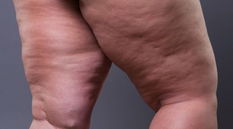 MENOPAUSA PODE DESENCADEAR LIPEDEMA: ENTENDA A RELAÇÃO HORMONAL POR TRÁS DA DOENÇA