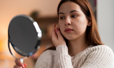 Por que a pele muda na adolescência e a acne costuma piorar justamente na volta às aulas?