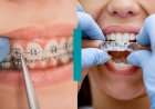 Como funciona um tratamento dentário com alinhadores invisíveis?