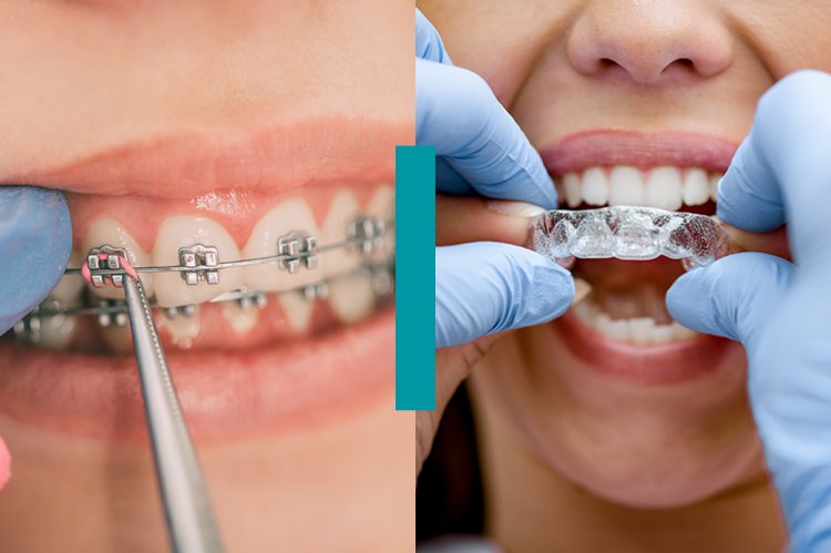 Como funciona um tratamento dentário com alinhadores invisíveis?